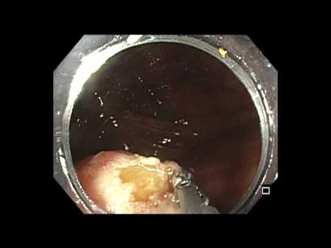 Colonoscopy: IC valve flat lesion hot biopsy avulsion