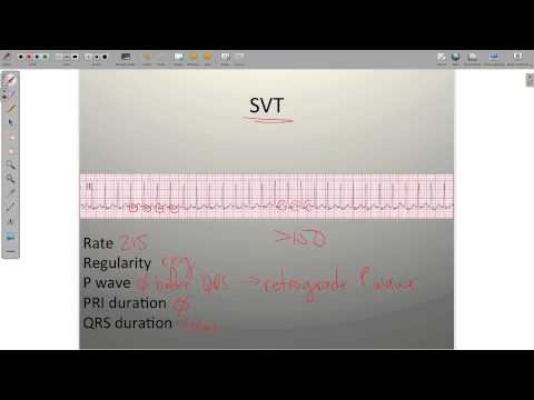 ECG Atrial Rhythms AF AFRVR SVT PAC