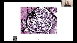 Glomerulopatías Primarias