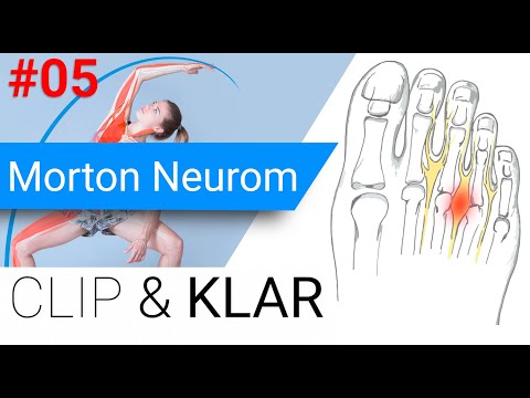 Morton Neurom erklärt - schmerzhafter Nervenknoten zwischen den Zehen