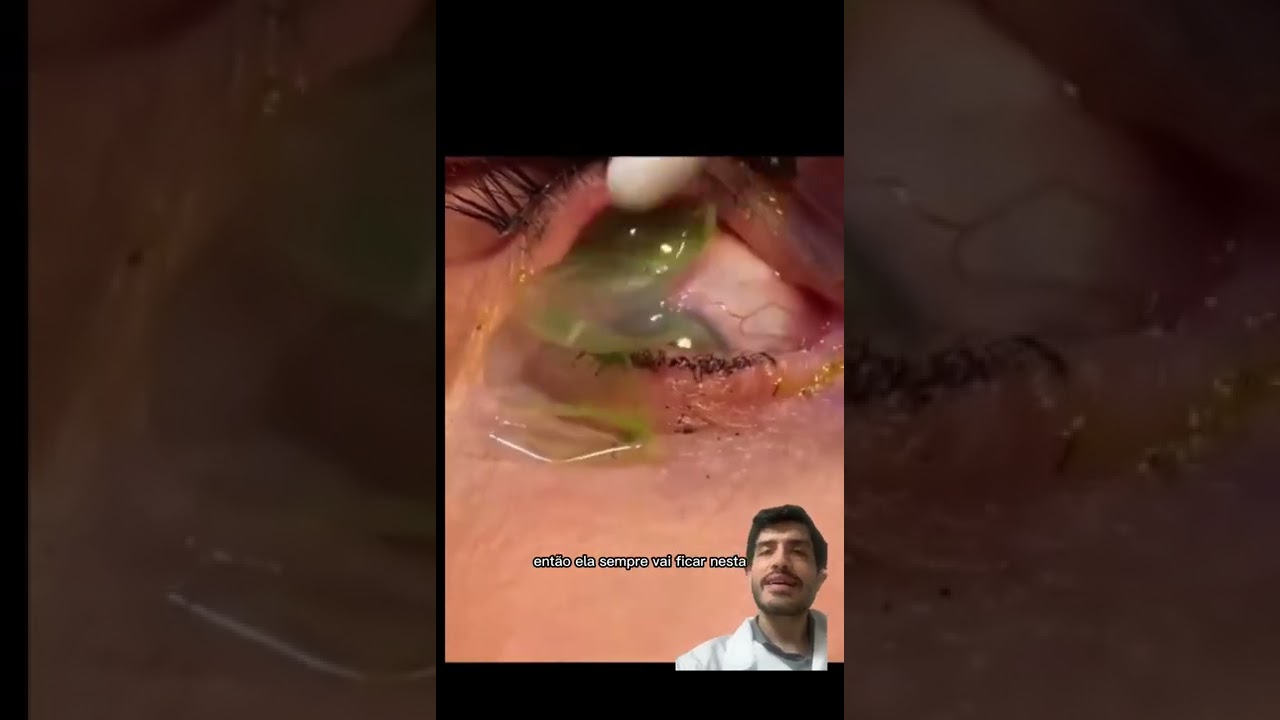Watch Now POSSO PERDER A LENTE DE CONTATO DENTRO DO OLHO POSSO PERDER A LENTE DE CONTATO DENTRO DO OLHO