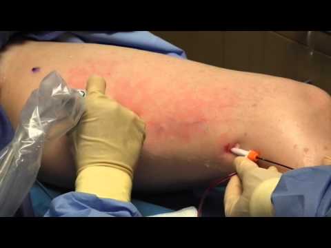 Cum să avertizați venele varicoase pe picioare