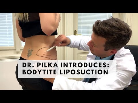 Dr. Pilka introduces BodyTite liposuction