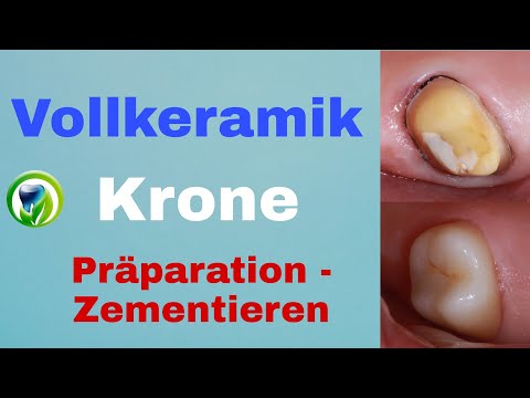 Vollkeramik-Krone im Seitenzahnbereich | Patientenfall,  Präparation, Einsetzen