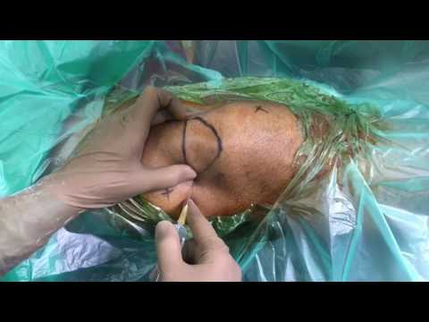 Dextrose Prolotherapy for Knee Pain