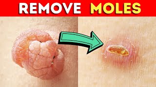 How to Remove a Mole Quickly With Castor Oil