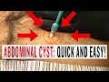 ABDOMINAL CYST QUICK AND EASY