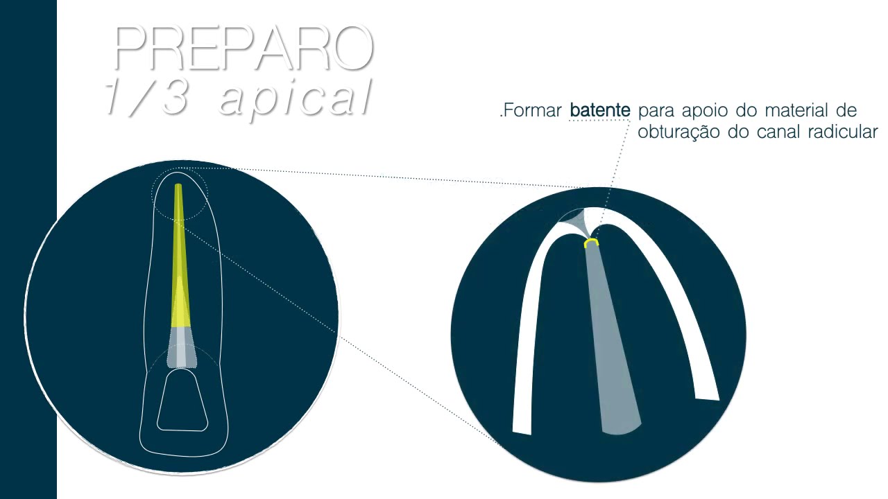 Preparo do terço apical em Endodontia