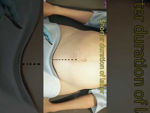 Normal Delivery or C-Section || What is the Best Option? #shorts