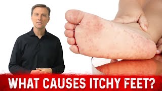 What Causes Itchy Feet and How to Stop It? – Dr. Berg