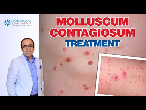 Molluscum Contagiosum Treatment | Dr Rohit Batra