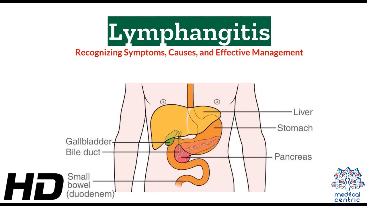 Lymphangitis 101: A Comprehensive Guide to Symptoms and Effects