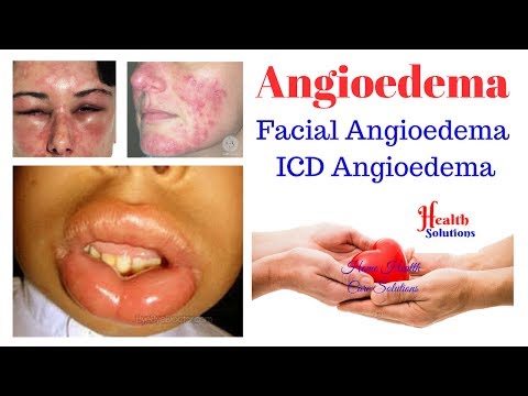Angioedema - Facial Angioedema - ICD Angioedema Video