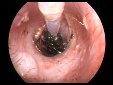 comment guerir gale dans le nez