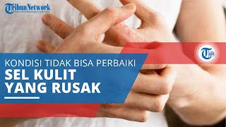 Eksim, Penyakit Kulit yang Muncul akibat Kulit Tidak Bisa Memperbaiki Sel yang Rusak