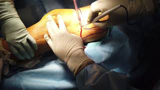 Wet Gangrene of the Foot