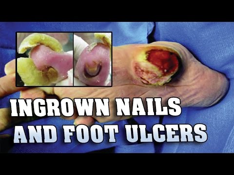 Kuko halamang-singaw shell Litrato fungus toe nail