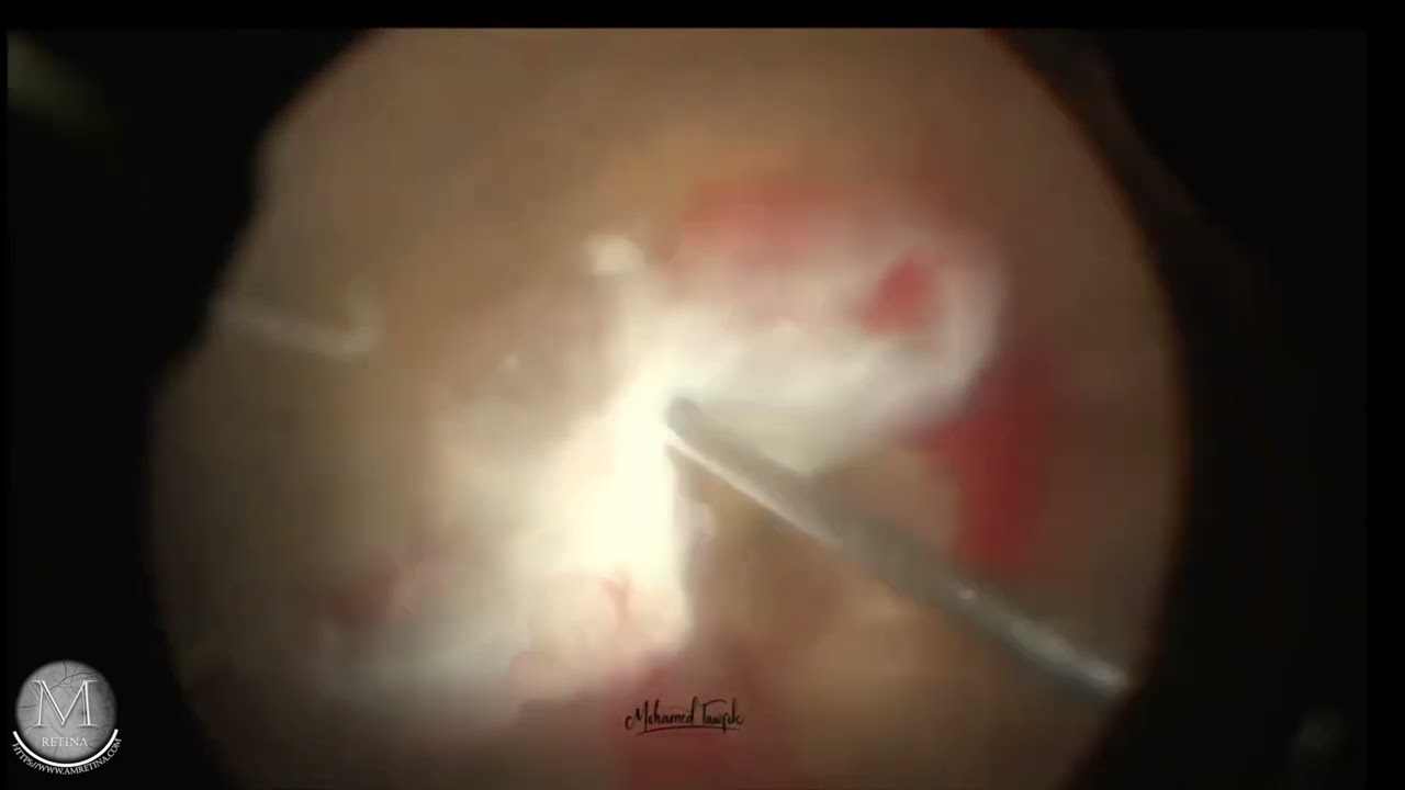 Diabetic Vitrectomy Strategies of Attack