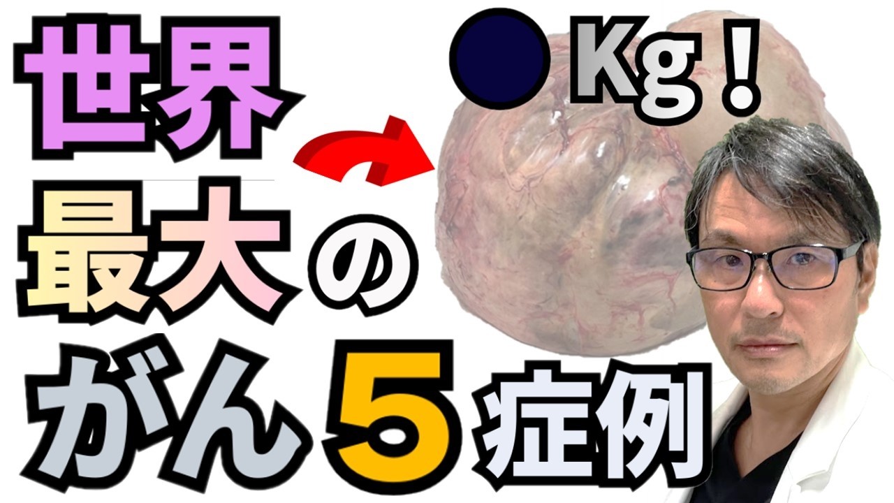【衝撃】世界でもっとも大きな「がん（腫瘍）」がすごかった！過去最大級の５症例を紹介