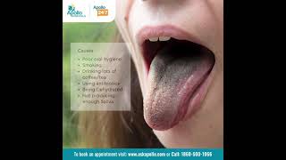 What is Black Hairy Tongue? How can it be prevented and managed? | Apollo Hospitals