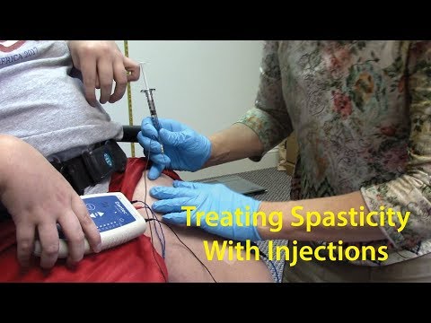 Treating Spasticity with Botox or Dysport Injections