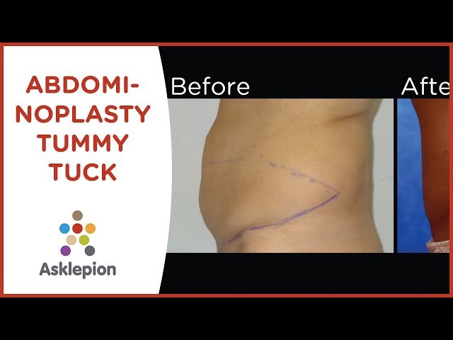 Abdominoplasty - Tummy Tuck