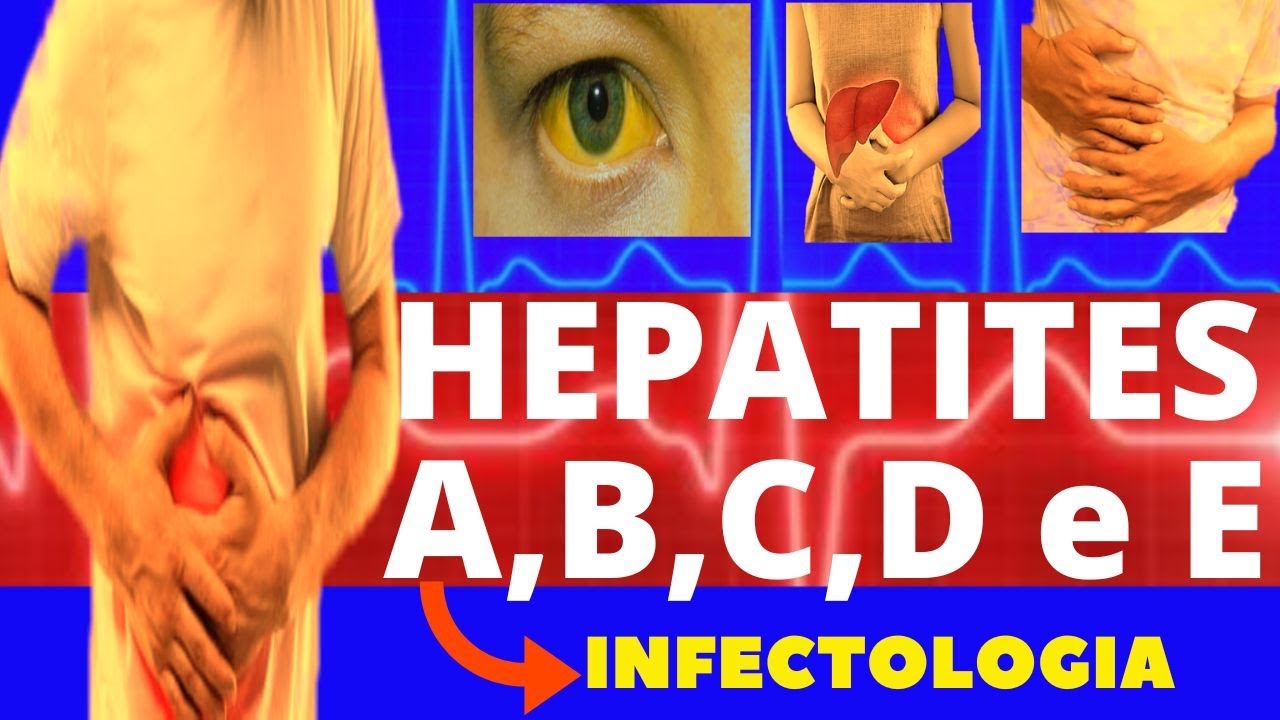 HEPATITES A, B, C, D e E - CARACTERÍSTICAS, SINTOMAS, DIAGNÓSTICO E TRATAMENTO - INFECTOLOGIA