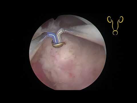 Bipolar En Bloc Prostate Enucleation 