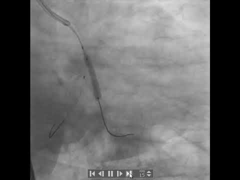 PCI to LCX-OM bifurcation using DK crush technique (case 5)(Delta Cath.Lab-Zagazig)