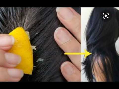 How to Remove Dandruff in One Wash || Dandruff Treatment At Home
