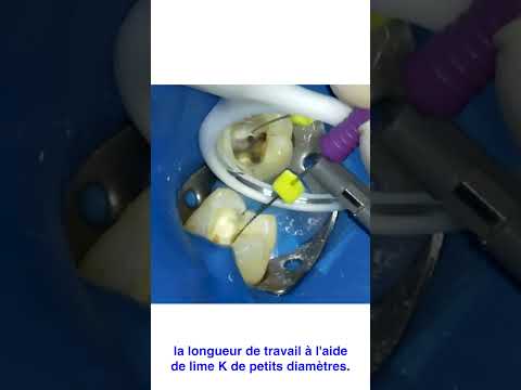Séquence MG3 sur une 16 avec MV2 partie 1 – Endodontie