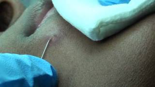 How to professionally fix a botched pimple-pop