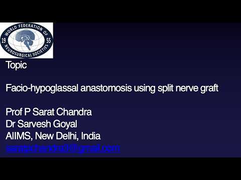 Facial–Hypoglossal Anastomosis with Split Nerve Graft
