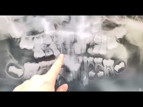 Explaining a child’s dental panoramic X-ray