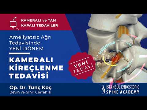 Yeni Kameralı Kireçlenme Tedavisi