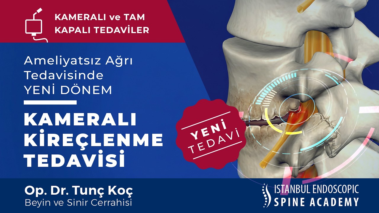Yeni Kameralı Kireçlenme Tedavisi