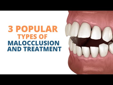 3 Popular Types of Malocclusion and How to Prevent them