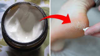 How to Heal Dry Cracked Heels at Home