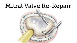 Mitral Valve Re-Repair: A Super-Specialty (with Dr. David Adams) video