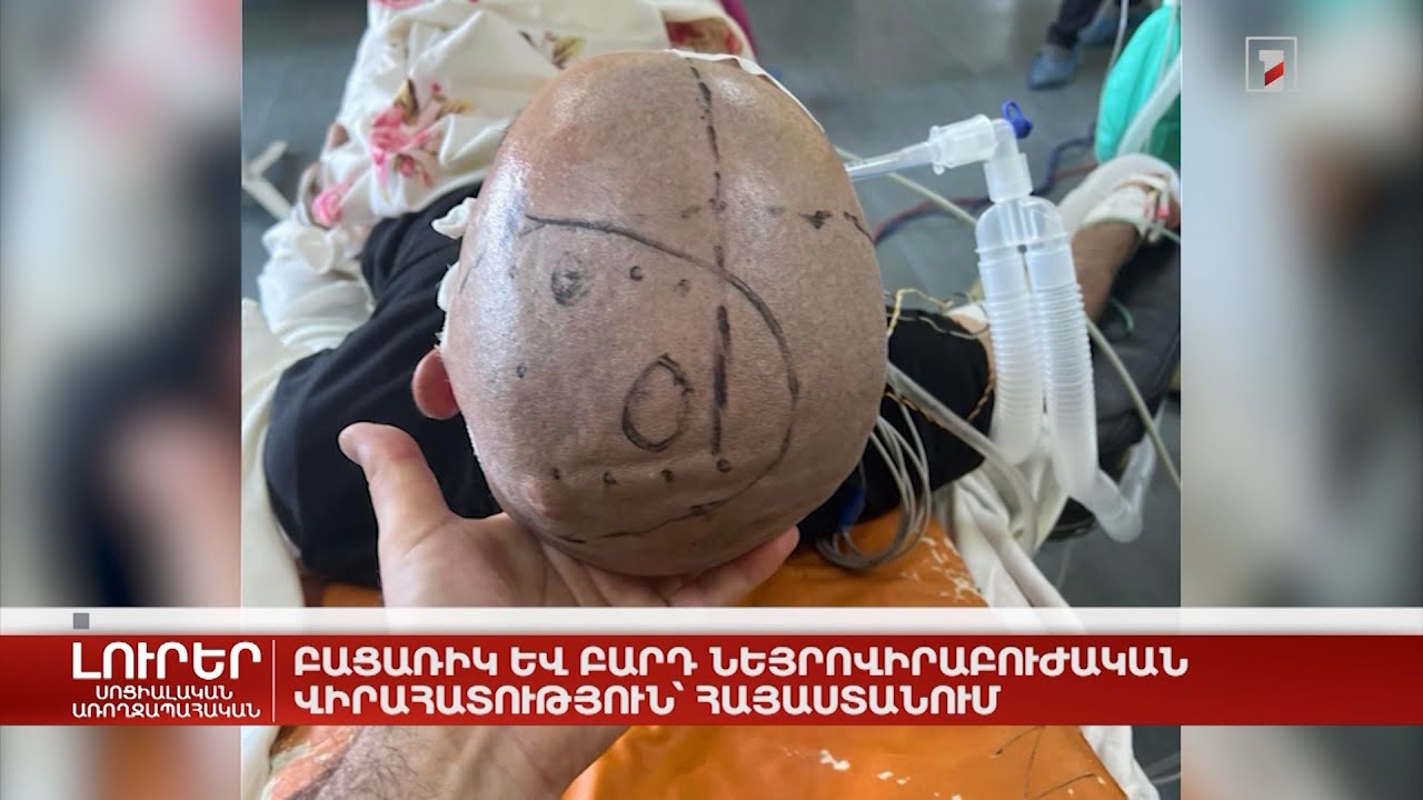 Բացառիկ և բարդ նեյրովիրաբուժական վիրահատություն՝ Հայաստանում