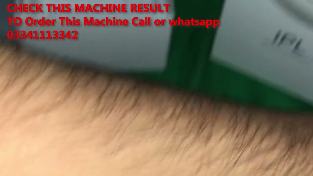 CkeyiN 990,000 Flashes IPL Permanent Hair Removal Device Review pakistan