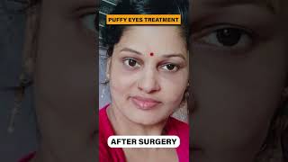 Get rid of Puffy Eyes forever in just 45 mins | Eye Bags Removal Surgery | Lower Lid Blepharoplasty