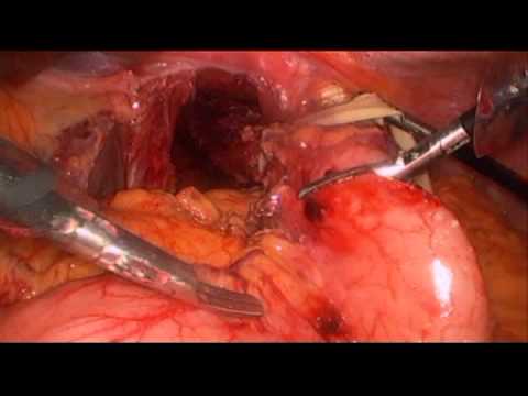 Reparación laparoscópica de una hernia combinada de Morgagni y paraesofágica