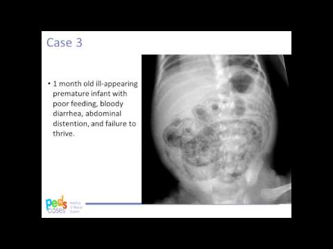 Approach to Pediatric Abdominal X-rays