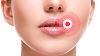 Poti face herpes de la oboseala sau daca mananci ceva stricat?