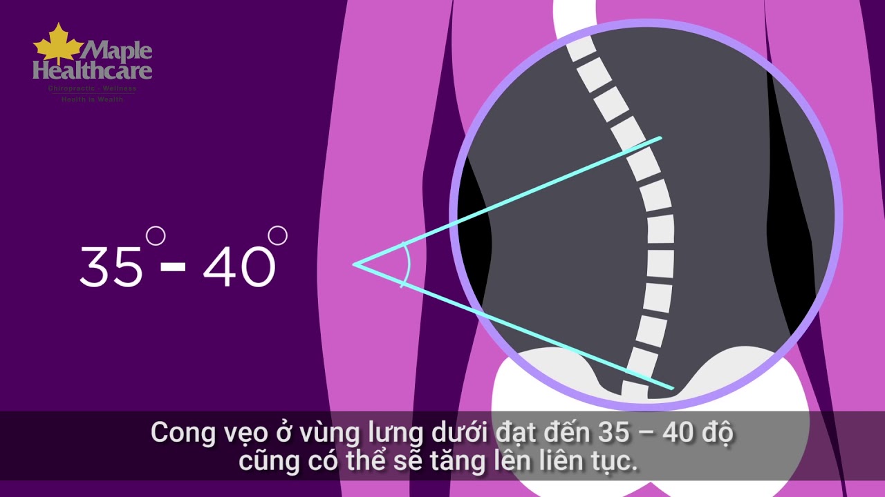 Vẹo