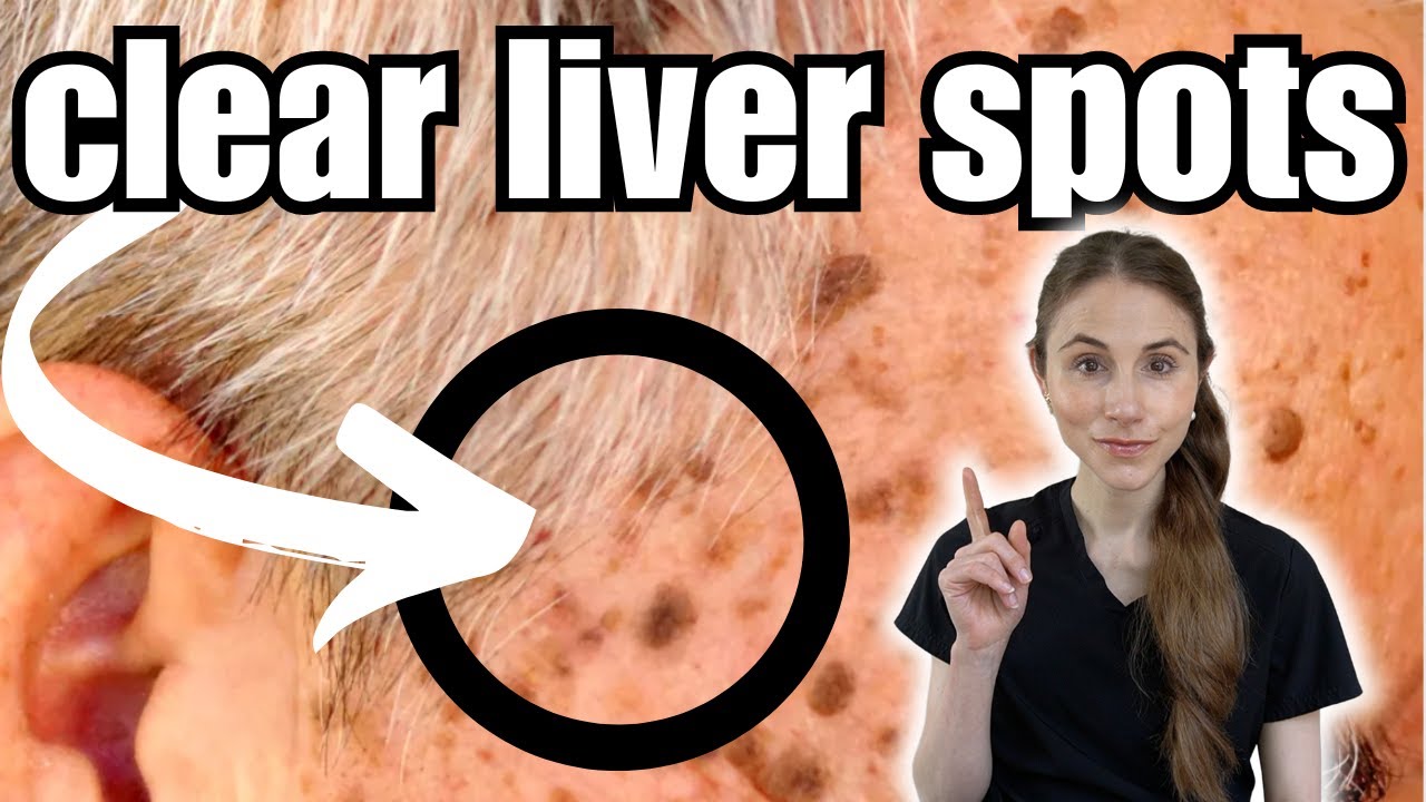Get Rid Of Liver Spots FAST | Seborrheic Keratosis
