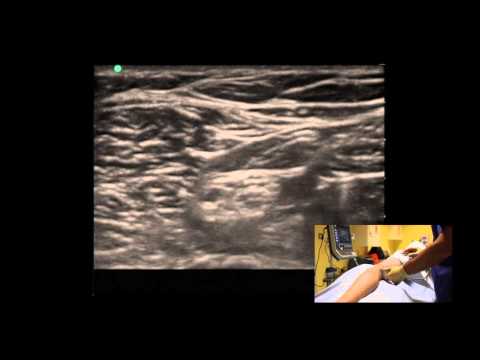 LSORA: US guided Popliteal Sciatic Regional Anaesthesia block