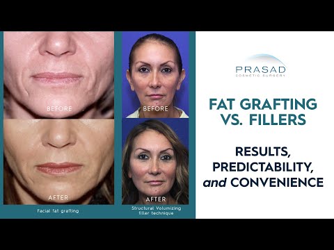 Facial Fat Grafting Versus Injectable Fillers - Important Factors to Consider