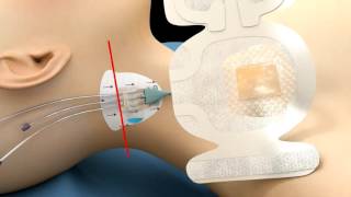 Product video: 3M Tegaderm PICC CVC Advanced IV Securement Dressing - 1837-2100, 1839 2100
